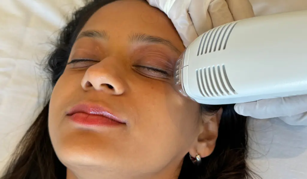Image showing the cutting-edge fractional skin treatment that uses controlled heat to improve texture, reduce pigmentation, and boost collagen with minimal downtime.